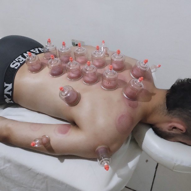 Adenilson Gomes realizando Ventosaterapia